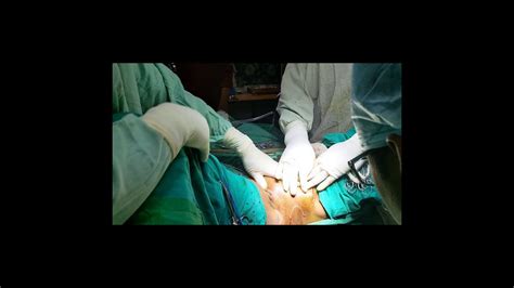 Leila Kasrai. . Penectomy post surgery pictures